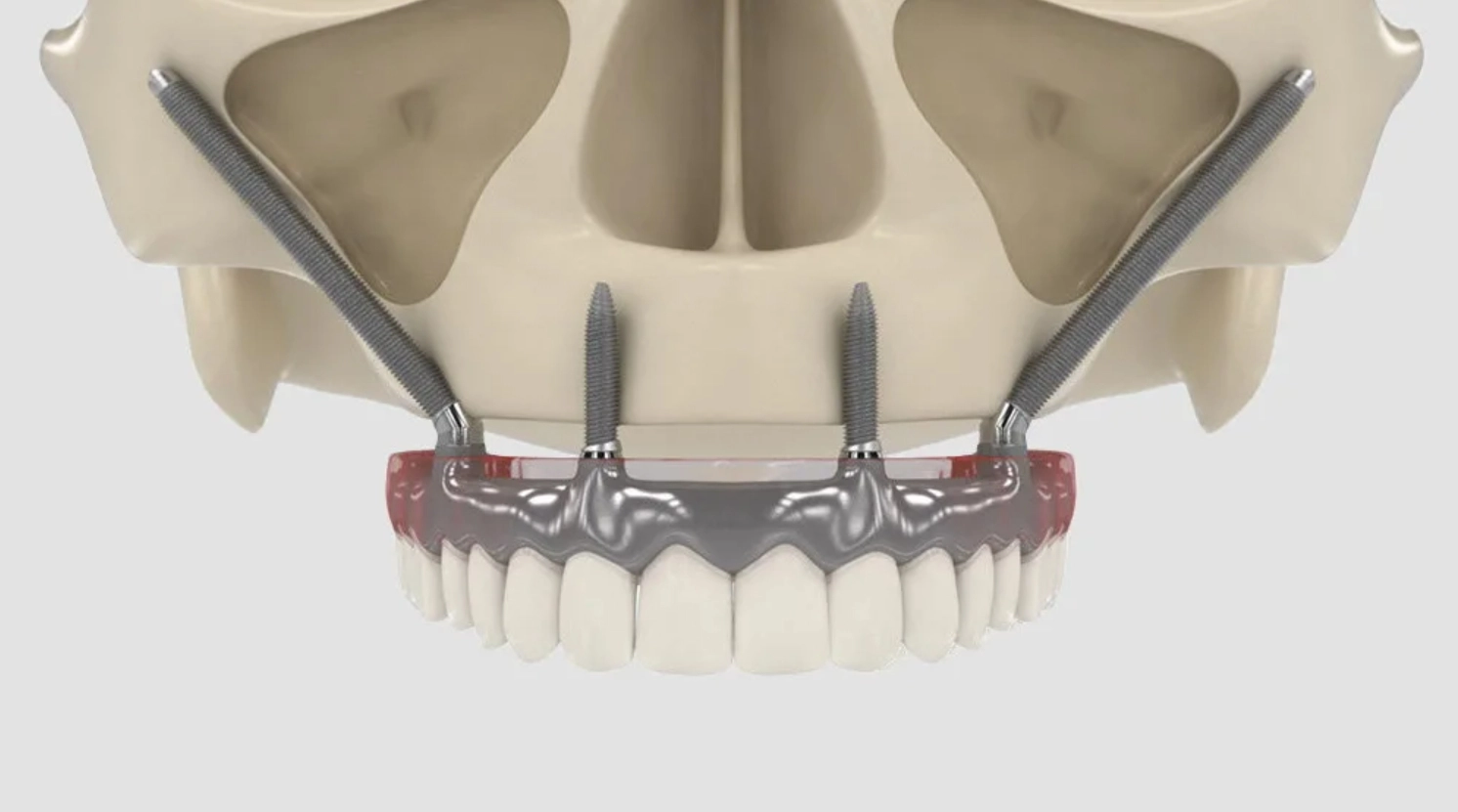 Имплантация Зубов Верхней Челюсти: Всё, что Нужно Знать